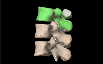 Spondylolisthesis: Causes, Diagnosis, and Treatment