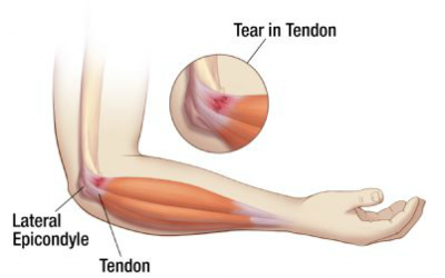 Understanding Tennis Elbow: Causes, Symptoms, and Effective Treatments