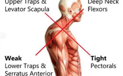 What is Upper Cross Syndrome ?