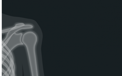Shoulder Pain: Common Causes and Uncommon Treatment