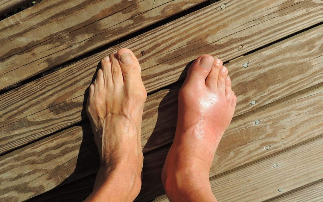 How To Get Rid Of Bunions Without Surgery